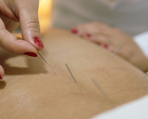 Dry Needling ergänzende Körpertherapie
