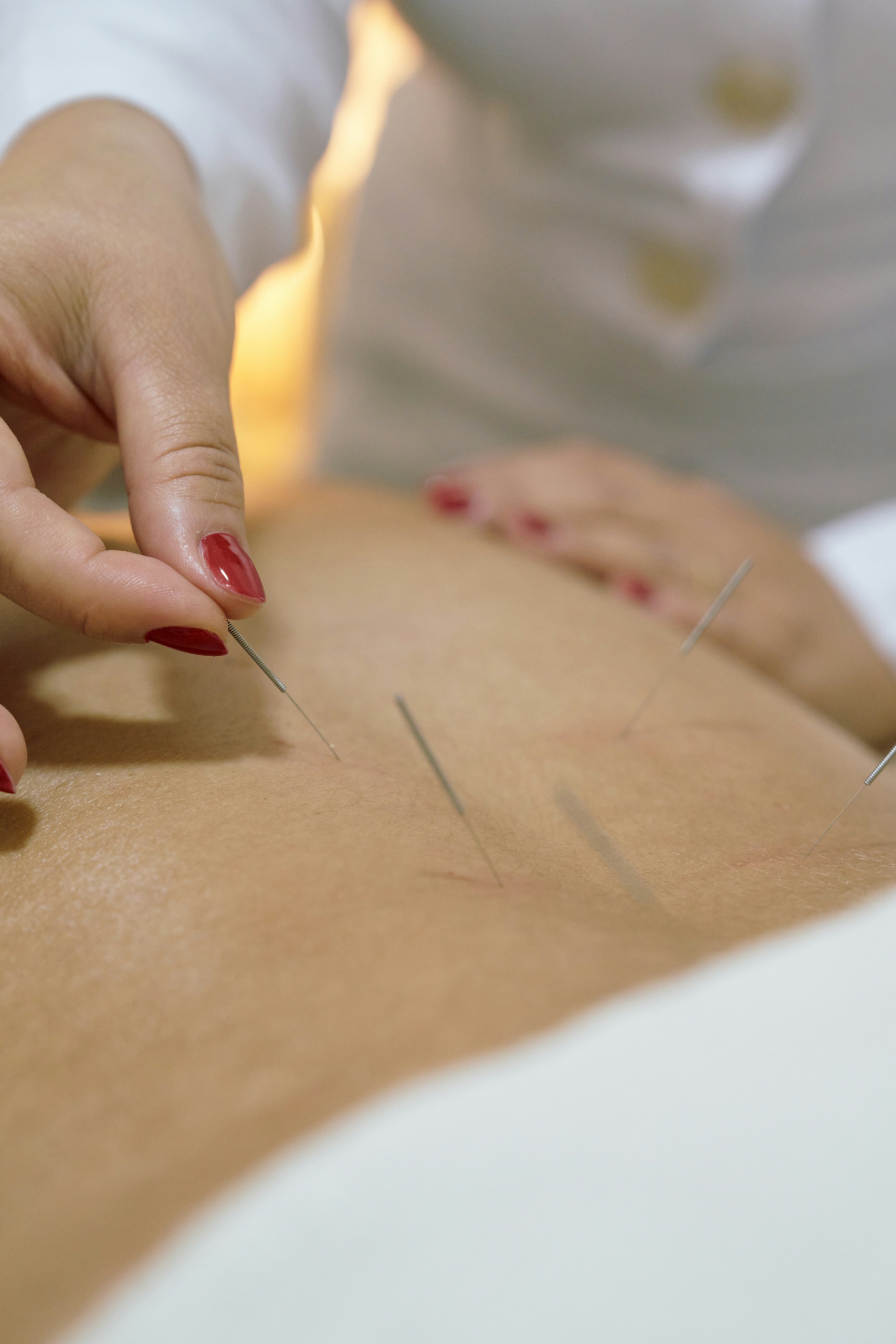 Dry Needling ergänzende Körpertherapie